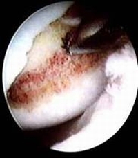Distal Femur Before Arthroplasty. Distal Femur Before Arthroplasty.